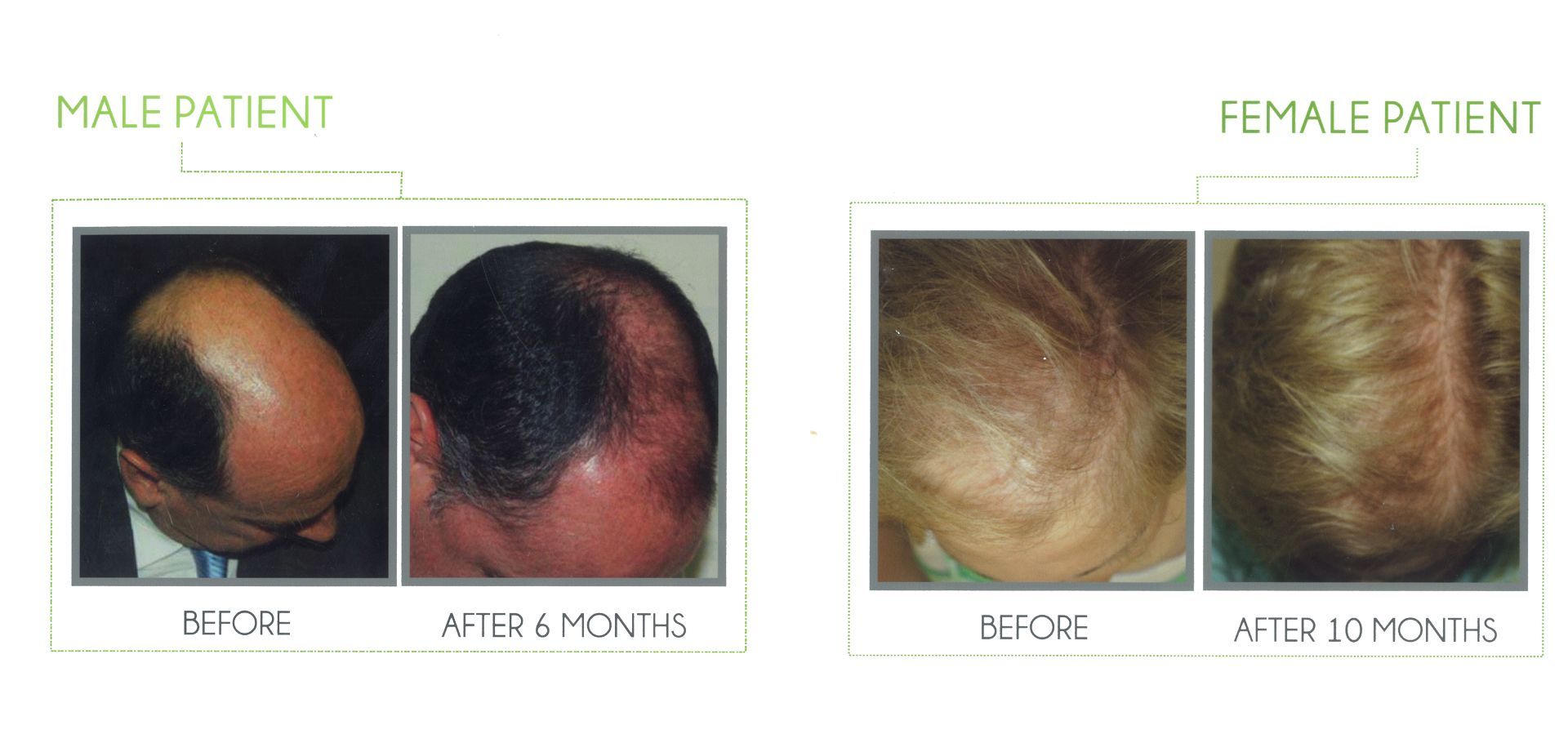 A before and after picture of a male and female patient's hair