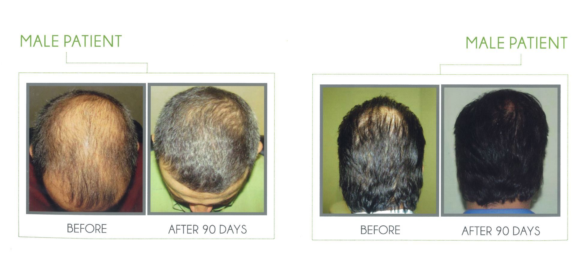 A before and after picture of a male patient's hair