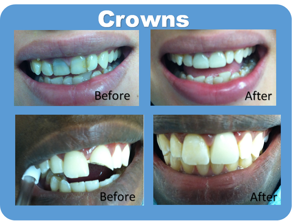 Crowns