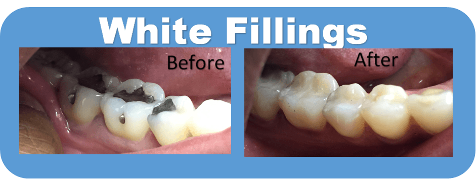 White Fillings