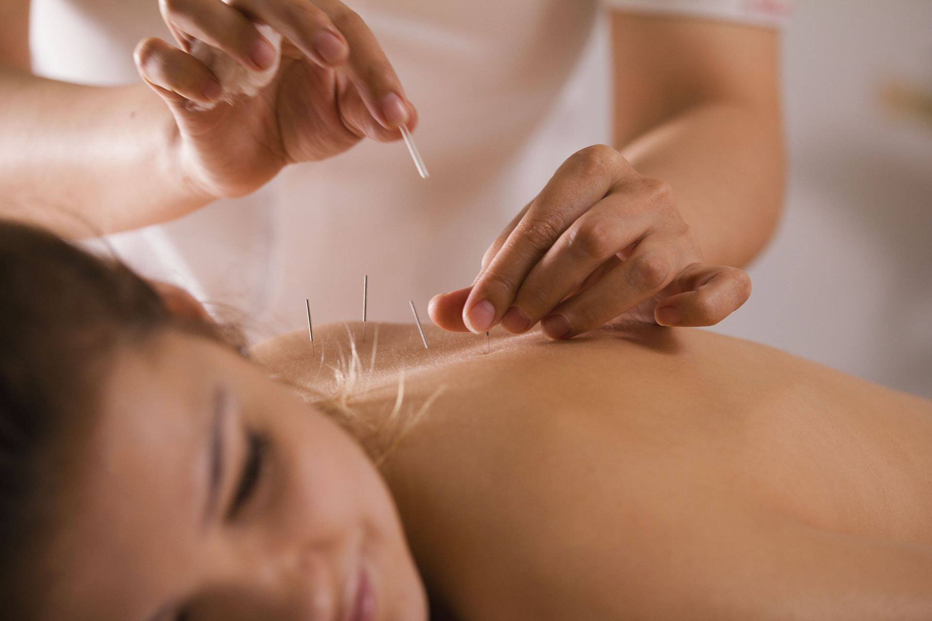 A person receiving acupuncture: needles in their back; another person inserts a needle.
