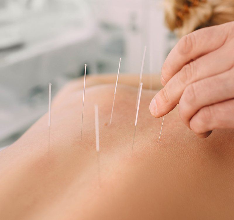 Acupuncture