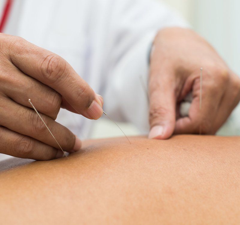 Acupuncturist eliminating pain