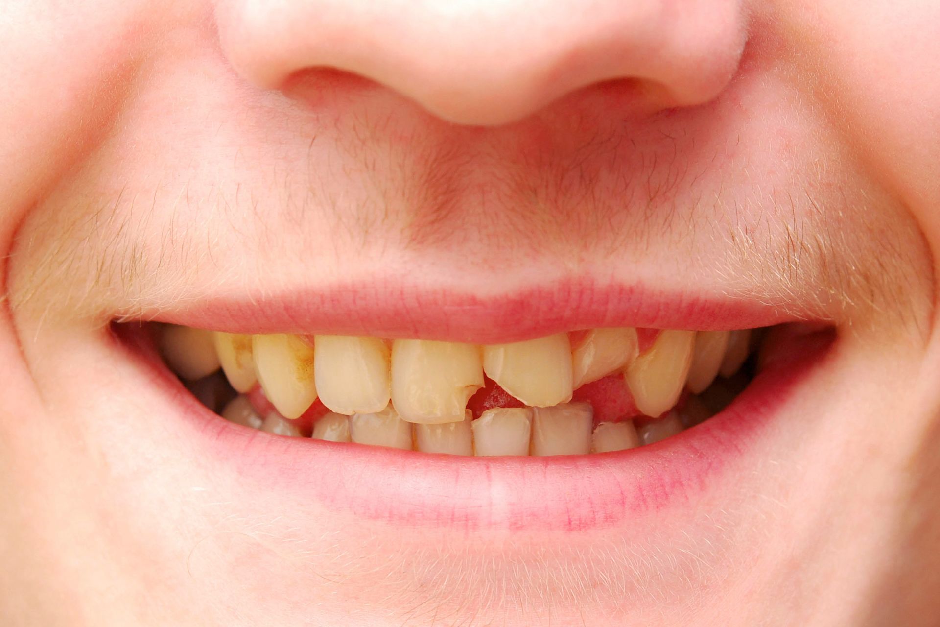 Close-up of a smiling mouth showing chipped and yellowed upper front teeth and red, inflamed gums.