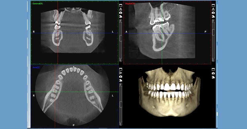 Dental cone-beam computed tomography (CBCT) scan showing four views of the teeth and jaw, including 3D reconstruction.