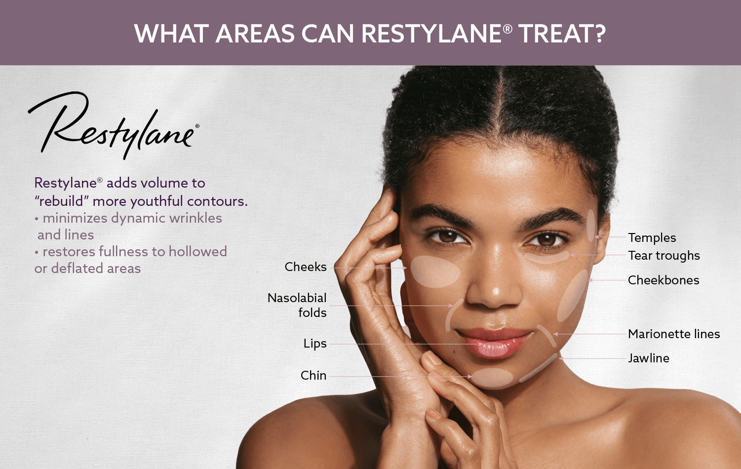 A woman's face is shown on a poster that says what areas can Restylane treat