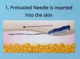 A preloaded needle is inserted into the skin.