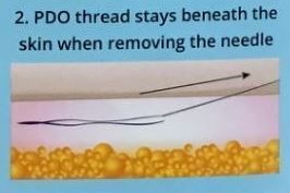 A pdo thread stays beneath the skin when removing the needle.