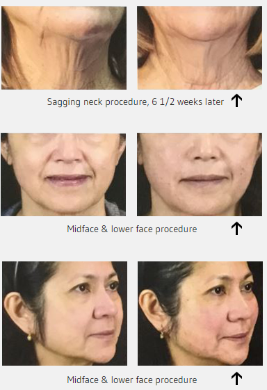 A woman 's face is shown before and after a sagging neck PDO Threads procedure