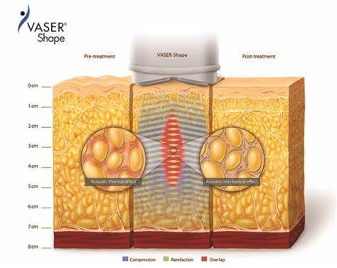 A diagram of a machine being used on a person 's skin.