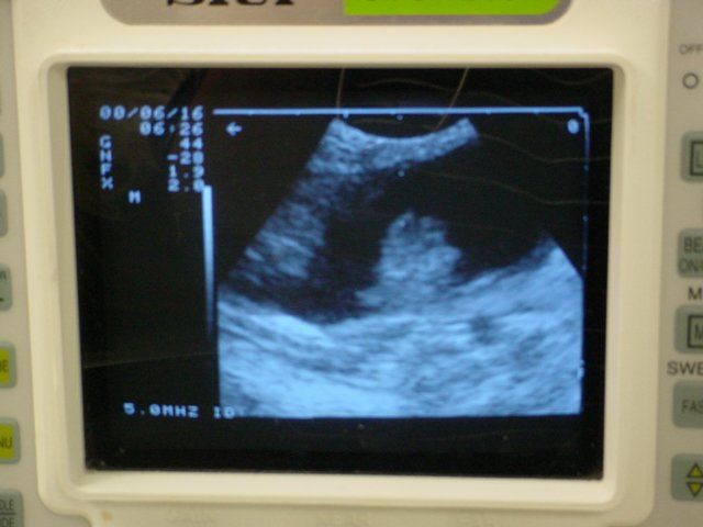 An ultrasound monitor shows a picture of a baby in the womb