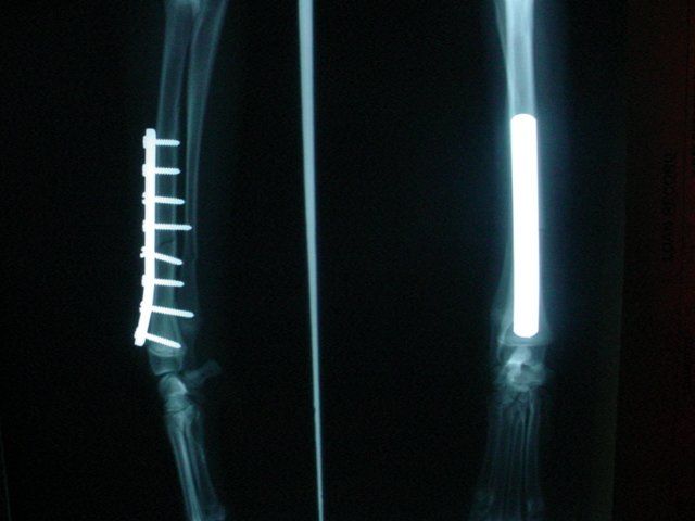 An x-ray of a person 's arm with a screw in it