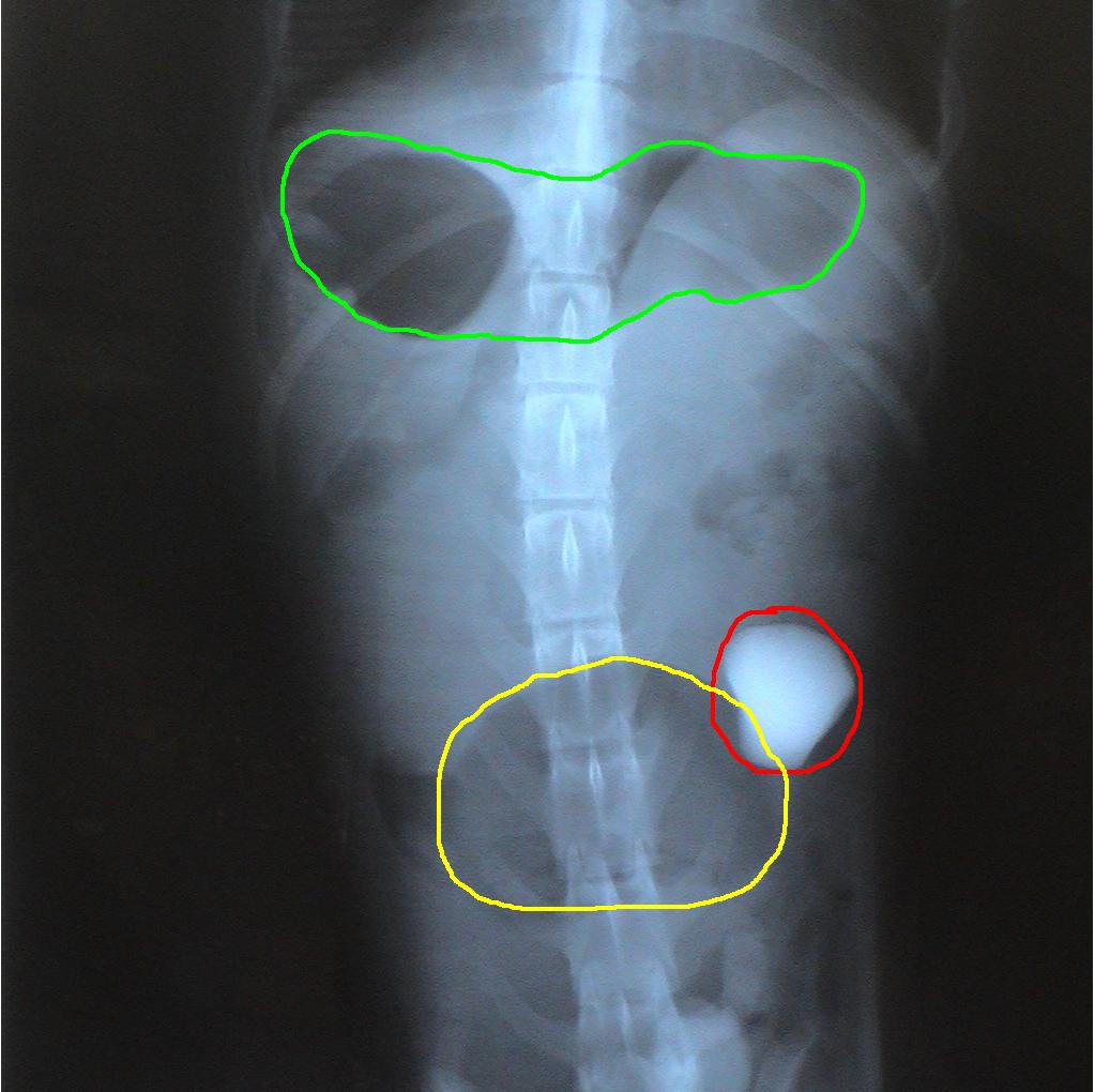 An x-ray of a person 's stomach with green circles and yellow circles