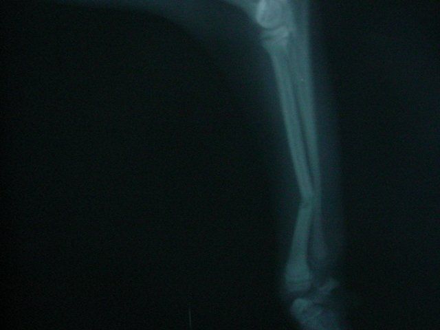 An x-ray of a person 's leg in a dark room.