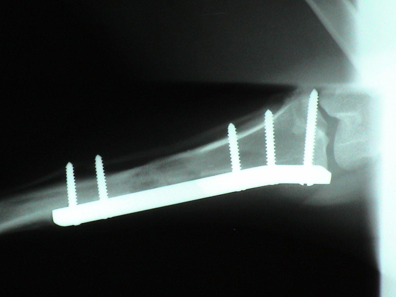 An x-ray of a bone with screws in it