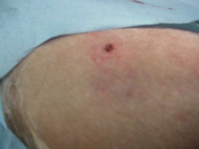 A close up of a person 's arm with a small hole in it