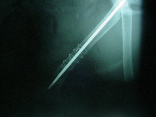 An x-ray of a person 's leg with a needle sticking out of it.