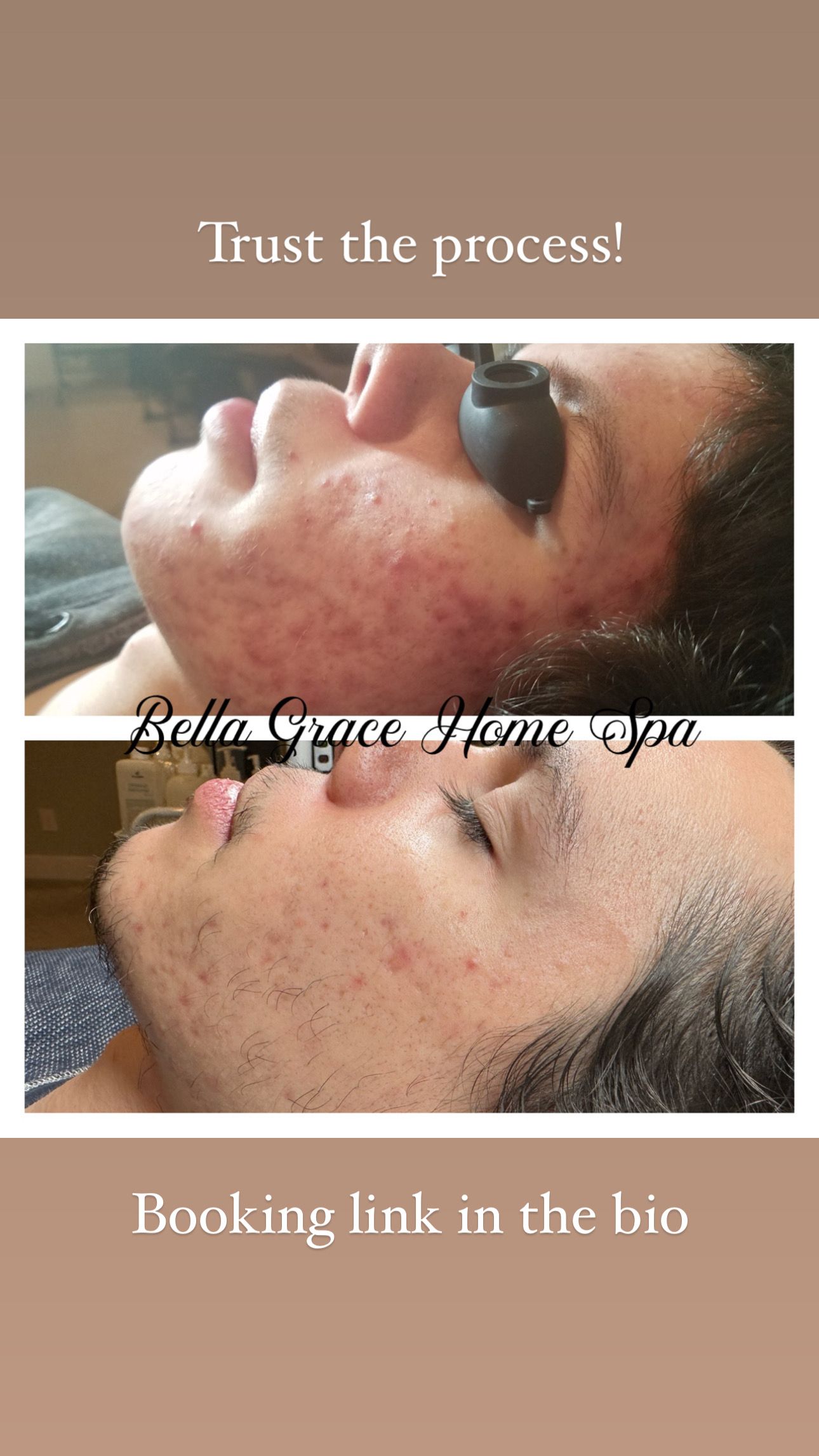 Before and after acne treatment showing improvement. A person's face in a spa setting.