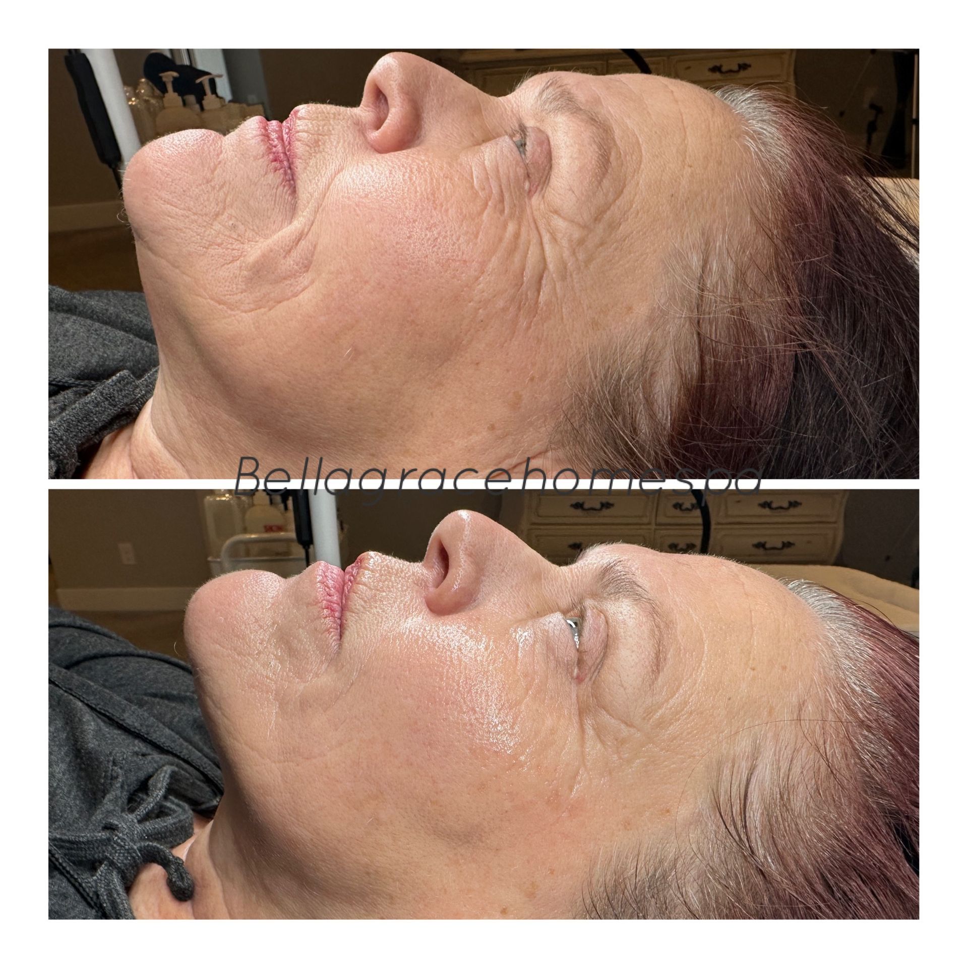 Before and after photos of a woman's face, showing wrinkle reduction. Top: wrinkled skin. Bottom: smoother skin.