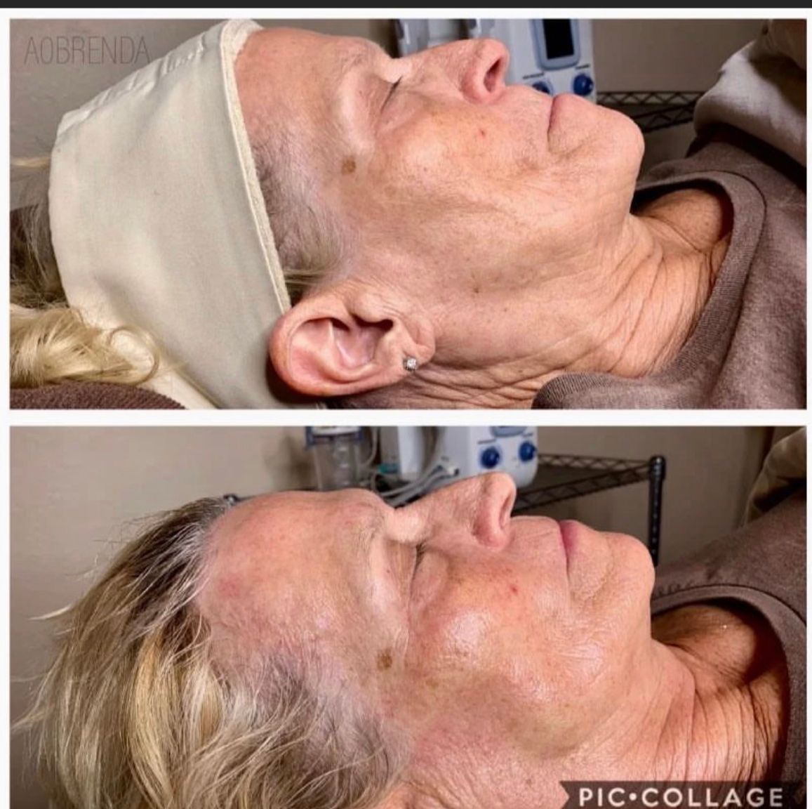 Before and after skin treatment: older woman, lying down, side profile, smooth skin.