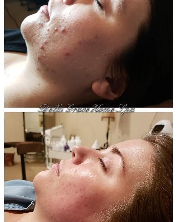 Before and after photos of woman's face. Shows acne before, clear skin after.