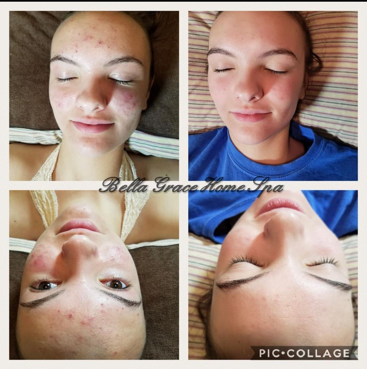 Before and after facial treatment collage; woman with acne, then clear skin.
