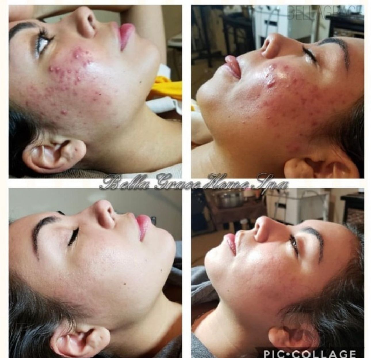 Collage showing a woman's acne-prone skin improving after treatments. Redness decreases, skin appears clearer.