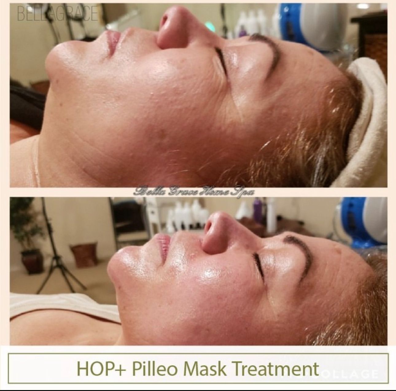 Two photos show a woman's face, before and after a HOP+ Pilleo Mask treatment. Her skin appears smoother in the second image.