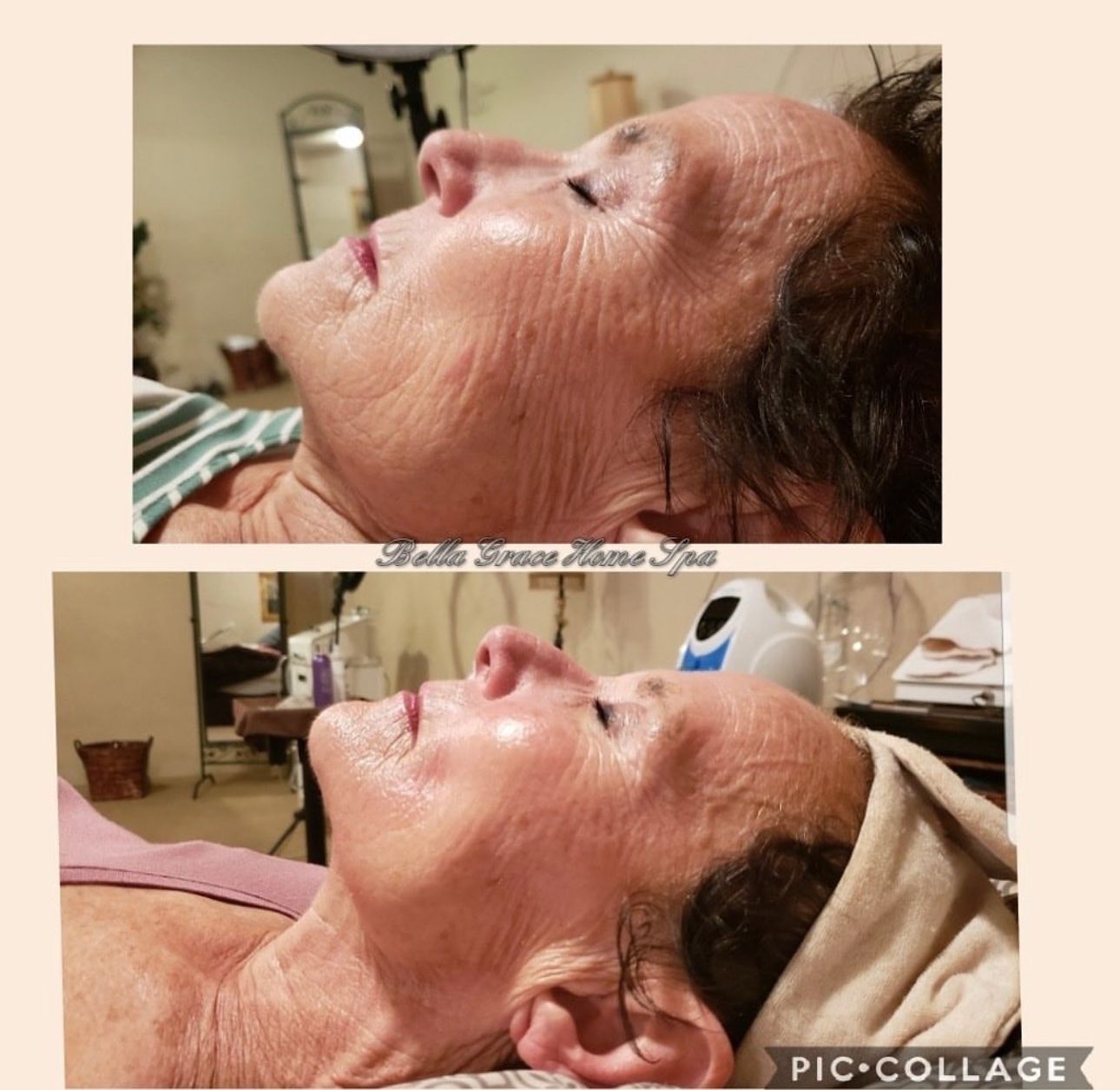 Side-by-side photos show before/after facial treatment of a woman with wrinkles, revealing smoother skin after.