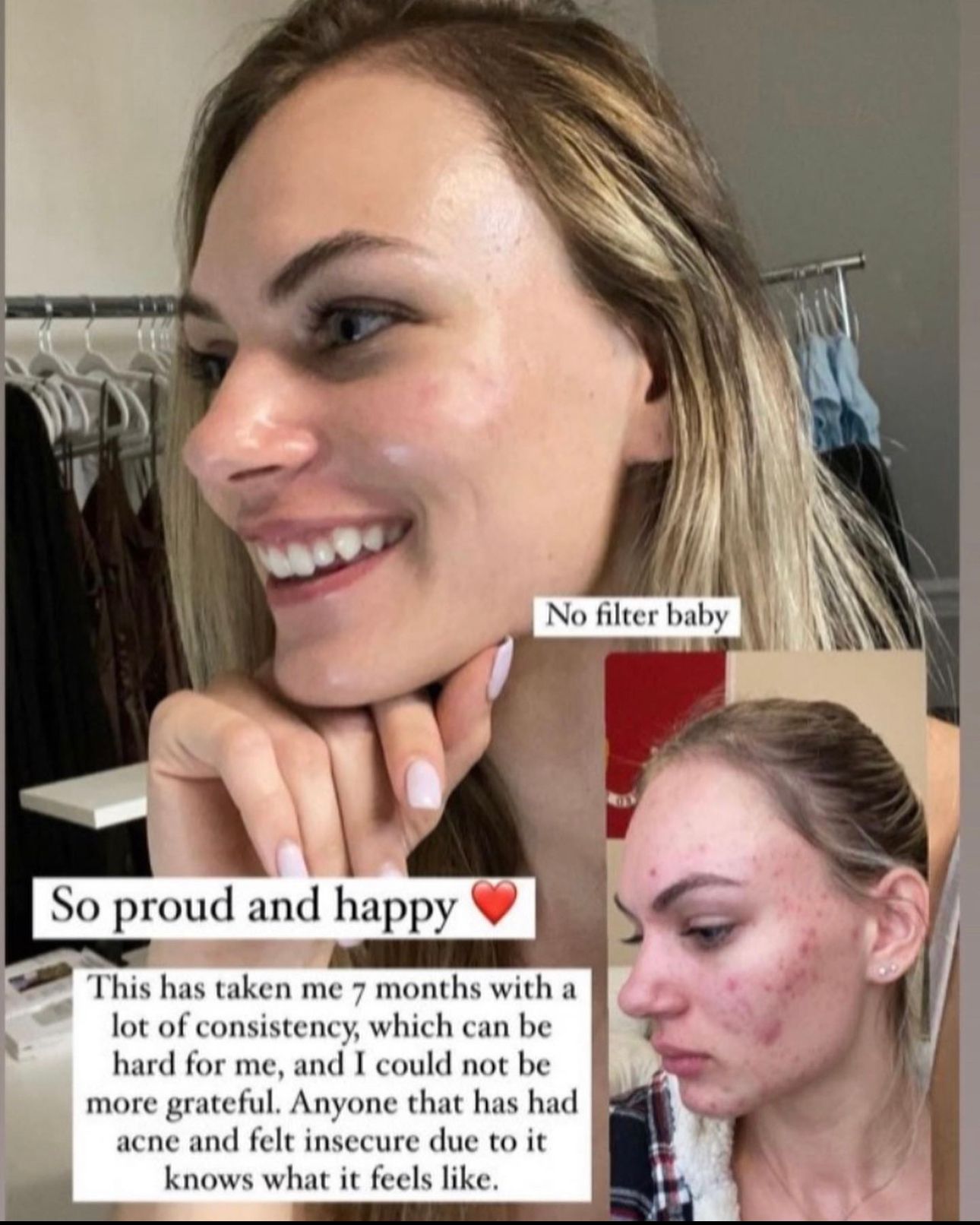 Before-and-after acne treatment. Woman smiles; inset shows face with acne. Text:
