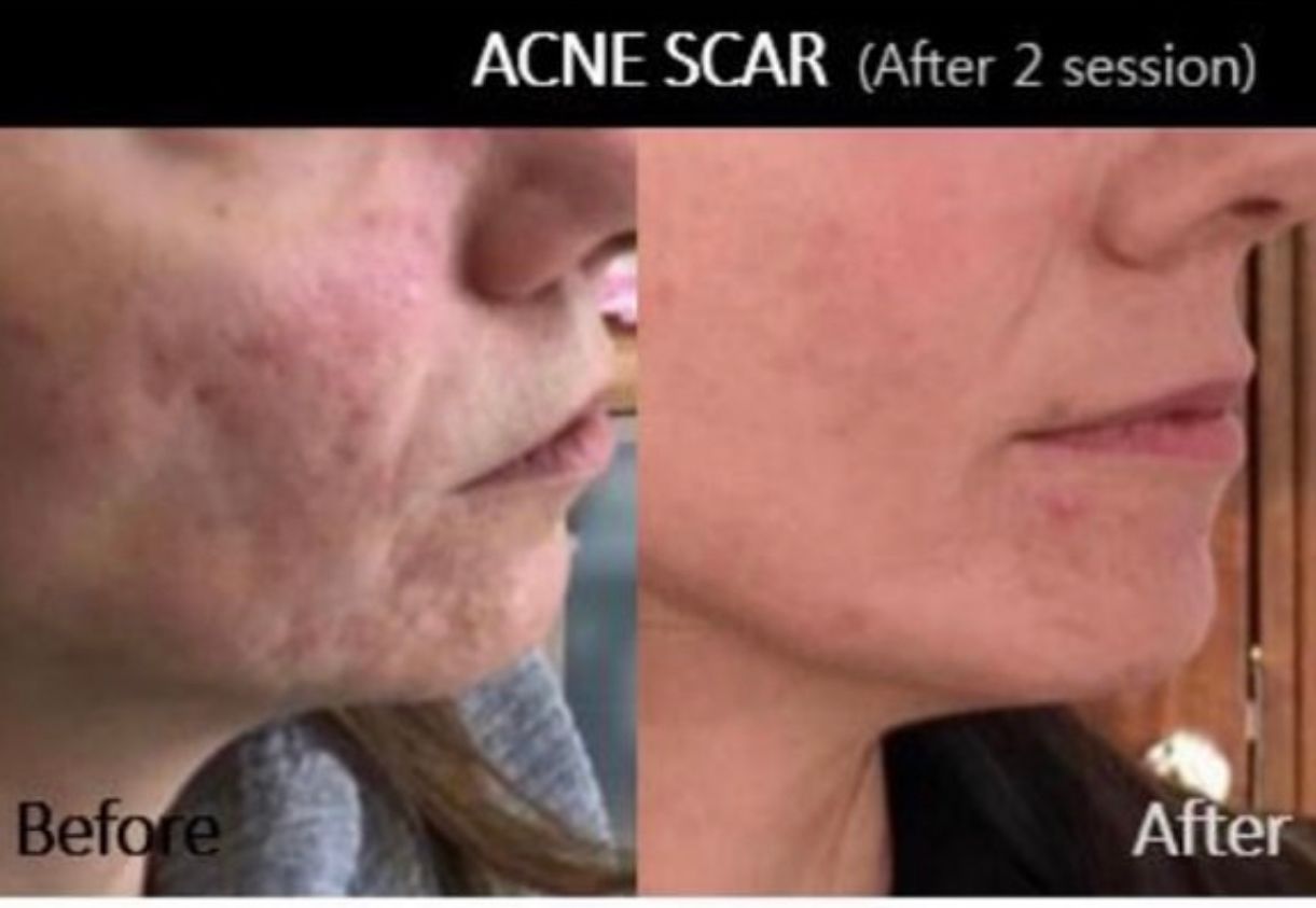 Before and after comparison: Acne scars on a woman's face visibly improved after two sessions.