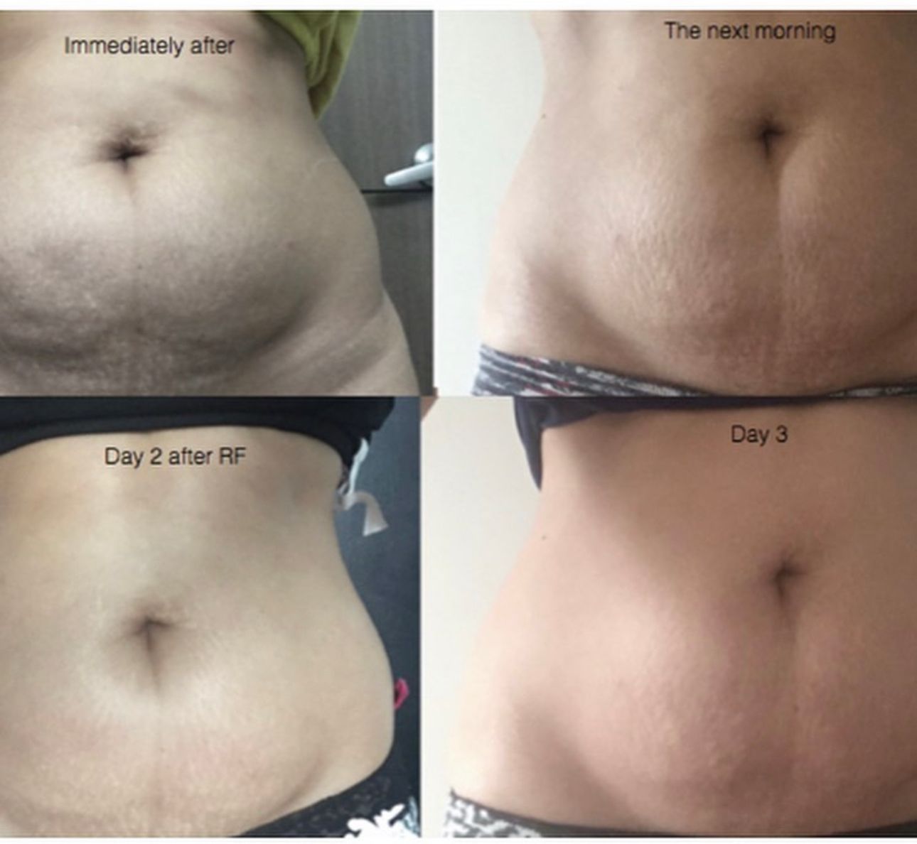 Four photos showing a person's abdomen before and after radio frequency treatment, illustrating a reduction in belly fat.