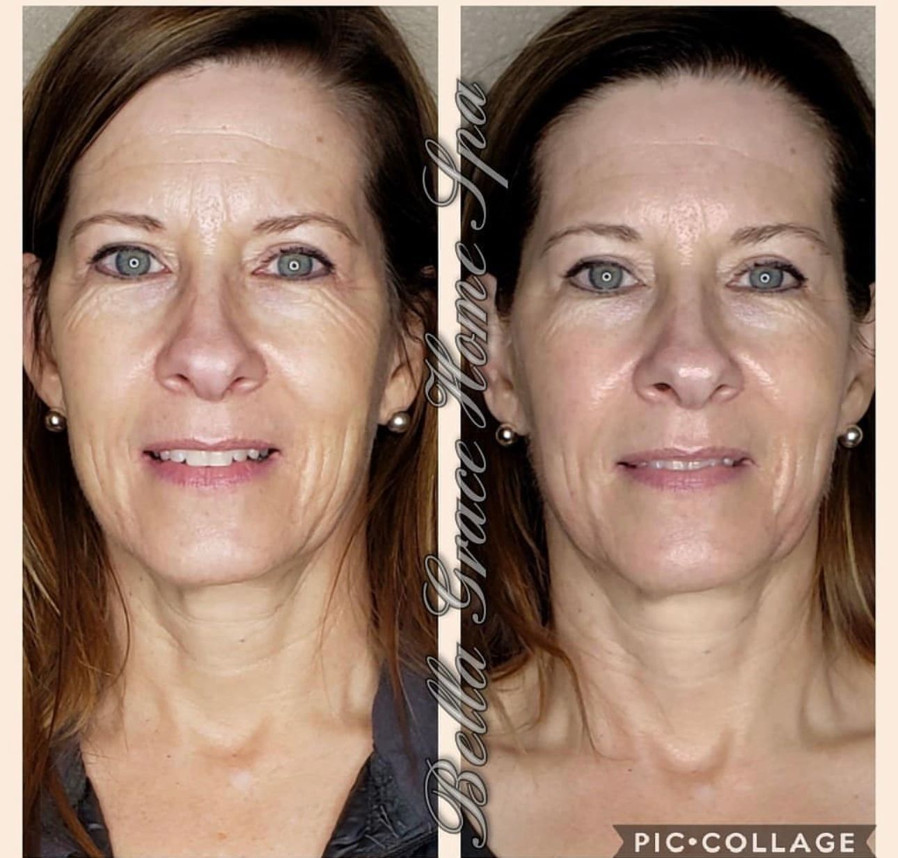 Before and after facial treatment photos. Woman with wrinkles, appearing younger in the after photo.