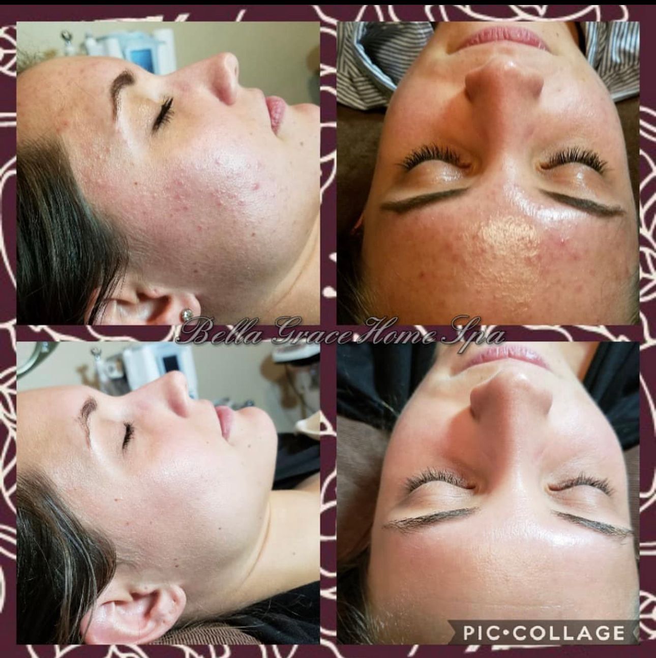 Collage of a woman's face. Photos show before and after skin treatments. Clearer skin is the goal.