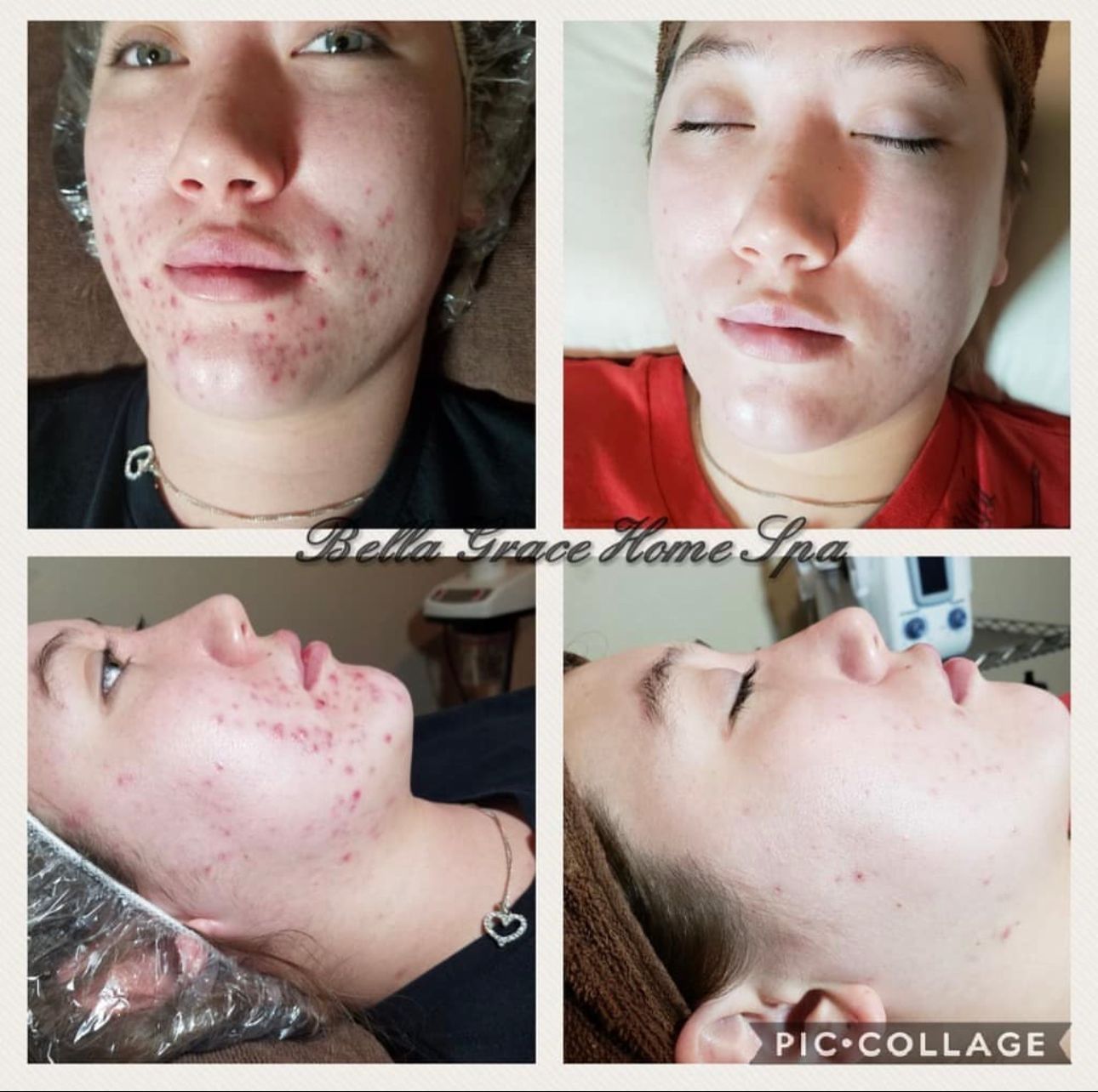 Before-and-after facial treatment: woman with acne before, then clear skin after at a spa.