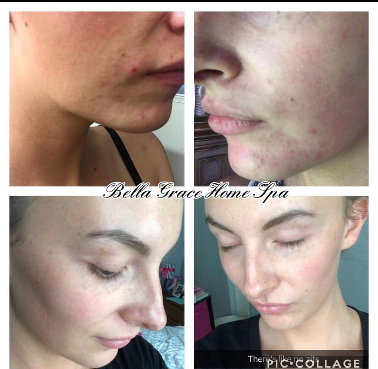 Four-panel comparison of a woman's face, showing acne before and after treatment, with improvements in skin texture and redness.