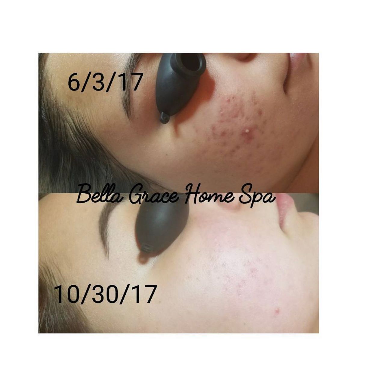Side-by-side photos show acne reduction on a face: before 6/3/17 and after 10/30/17 treatment at Bella Grace Home Spa.