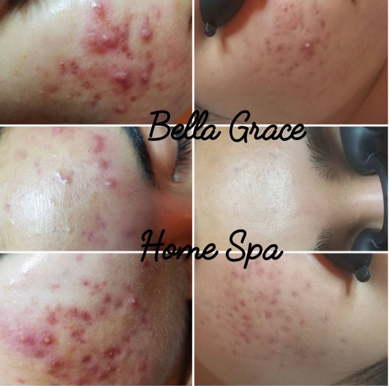 Progressive photos of skin treated for acne; various red bumps reduce in size.