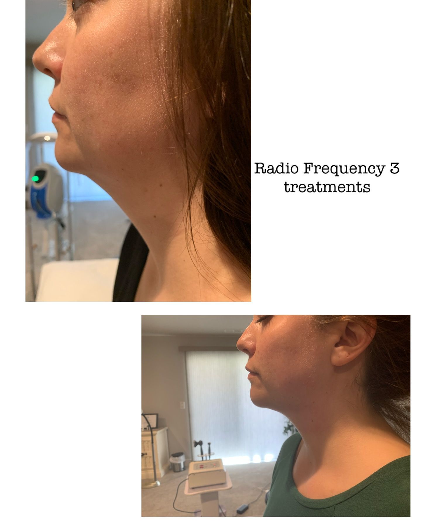 Two side-view photos of a woman's neck and chin; before and after five radio frequency treatments, showing a reduction in fullness.