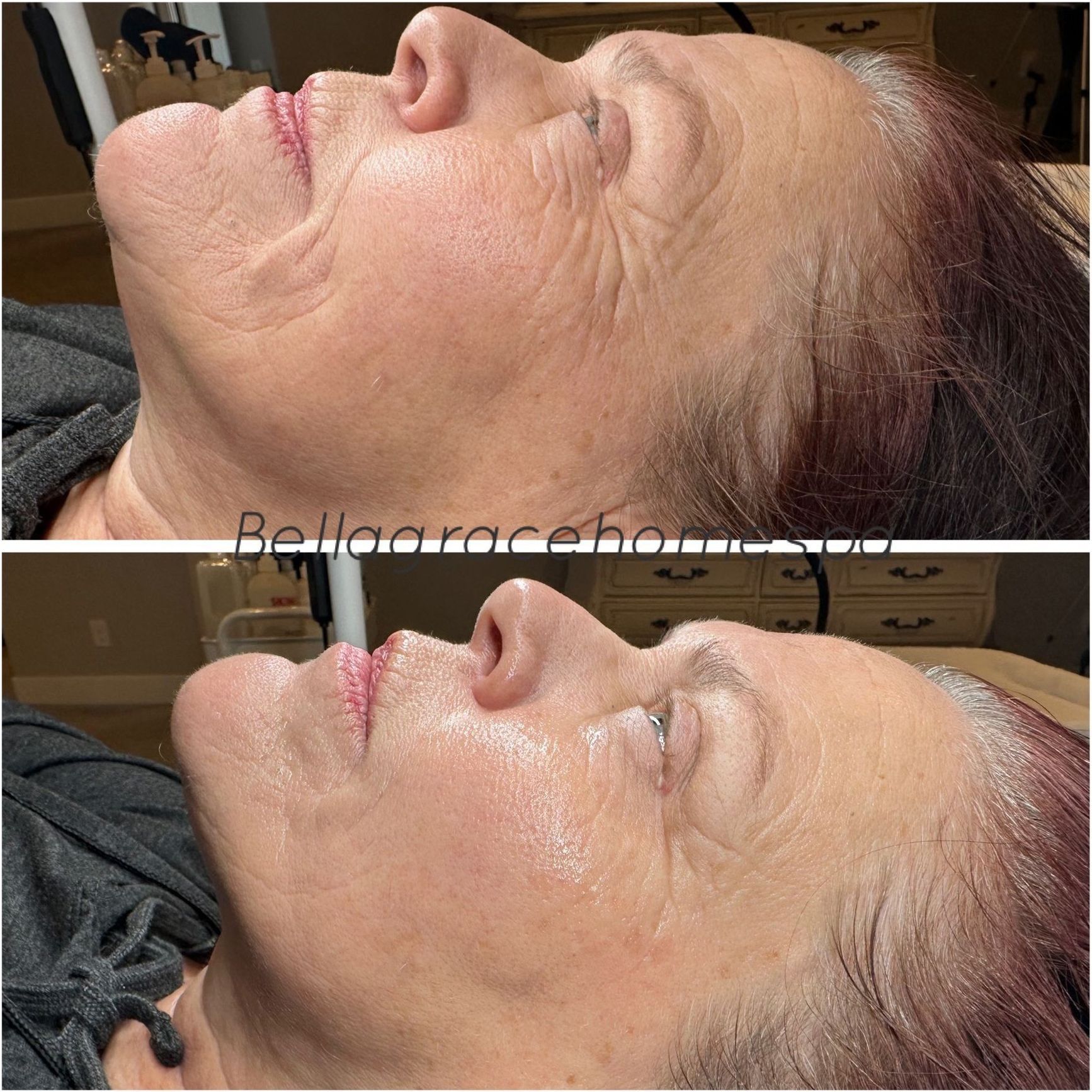 Before and after profile view of a woman's face. Skin appears less wrinkled after a facial treatment.