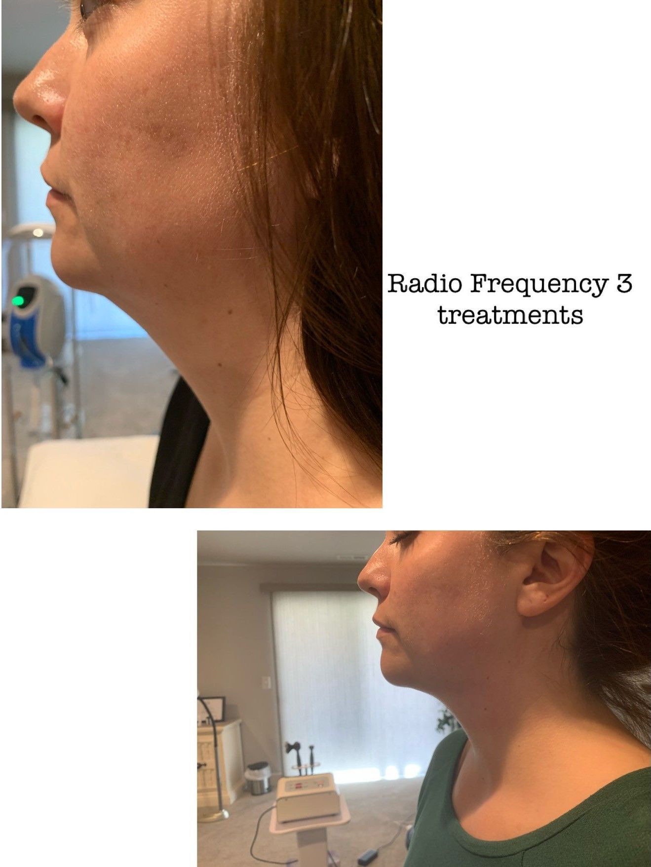 Side-by-side comparison of a woman before and after radio frequency treatments to reduce neck fat.