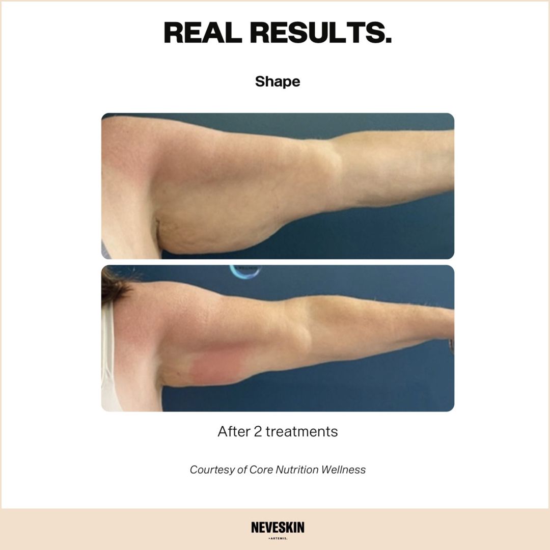 Arm contouring treatment result