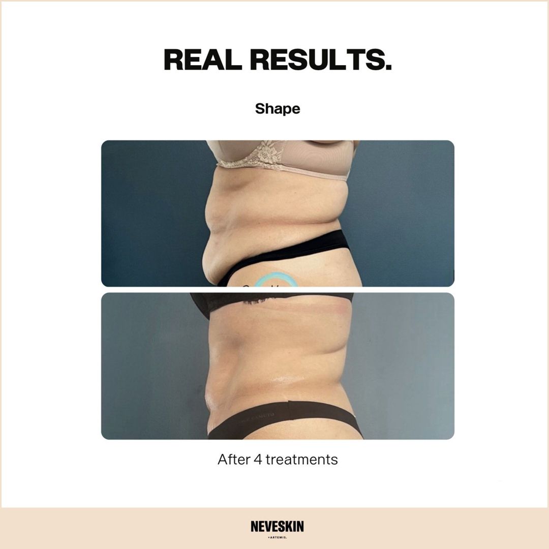 Body contouring treatment result