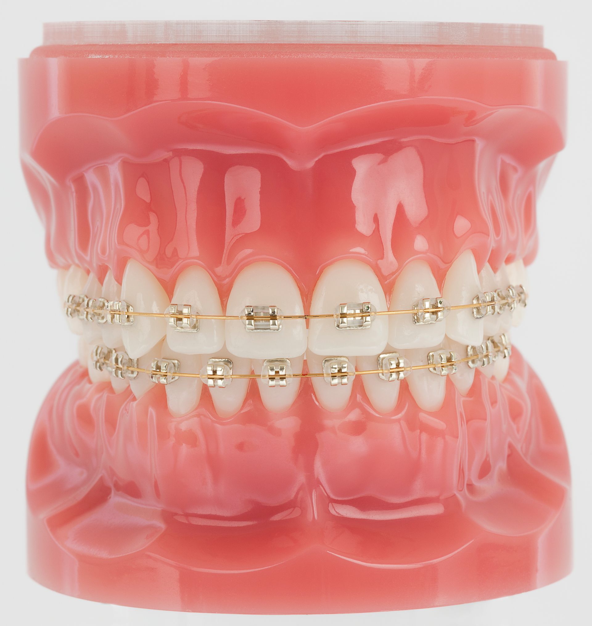 A model of a person's teeth with braces on them