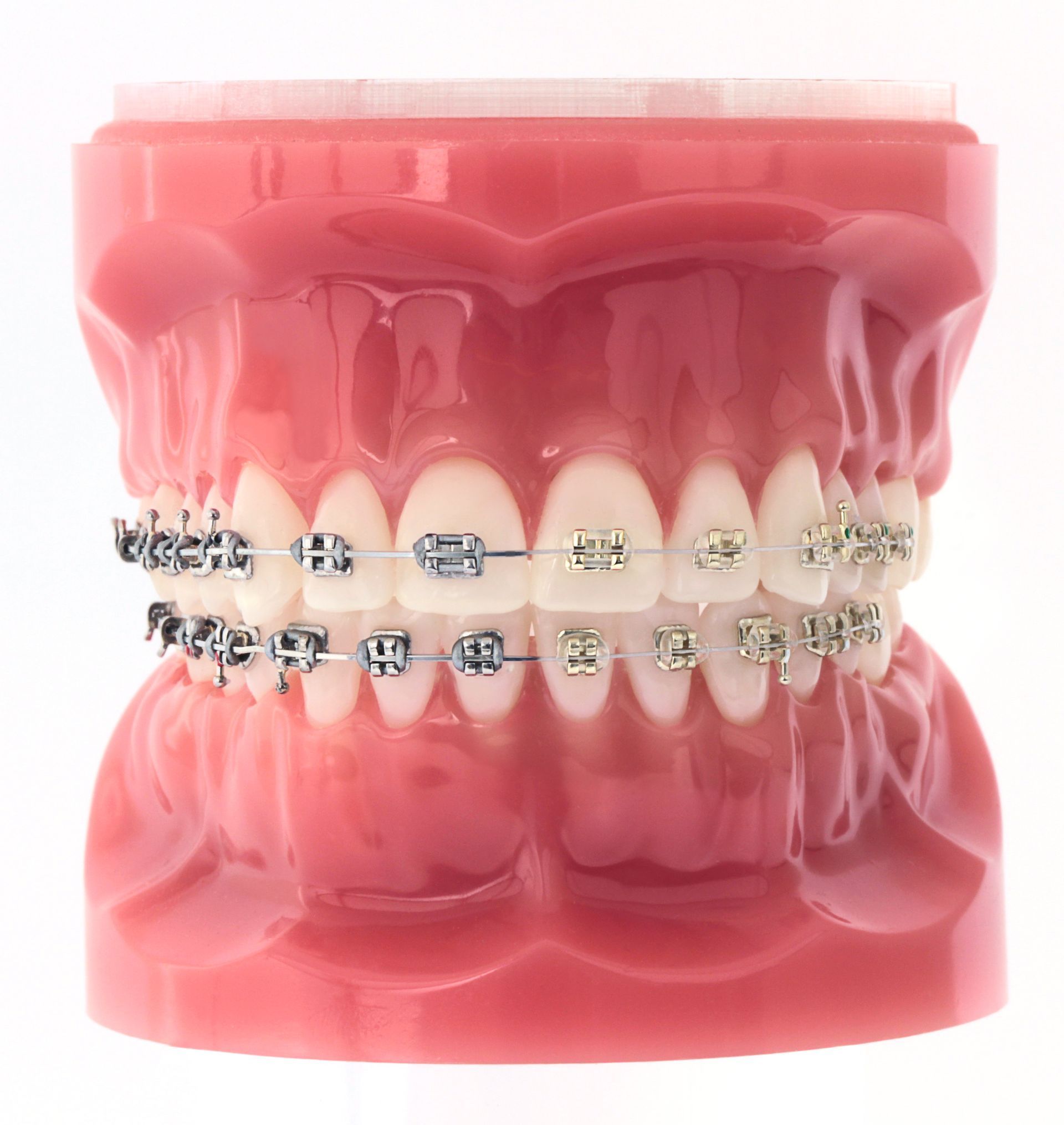 A model of a person's teeth with braces on them.