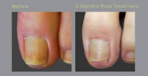 Cutera fungal nail before and after