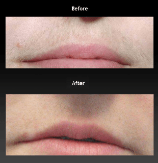 before and after hair removal
