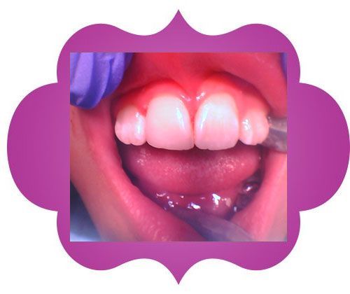 A child's teeth being check - after