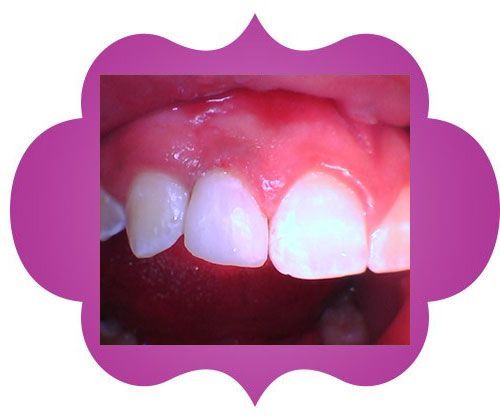 Close up of a teeth -after