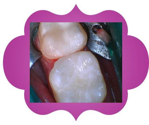 A close-up of a person's teeth - after